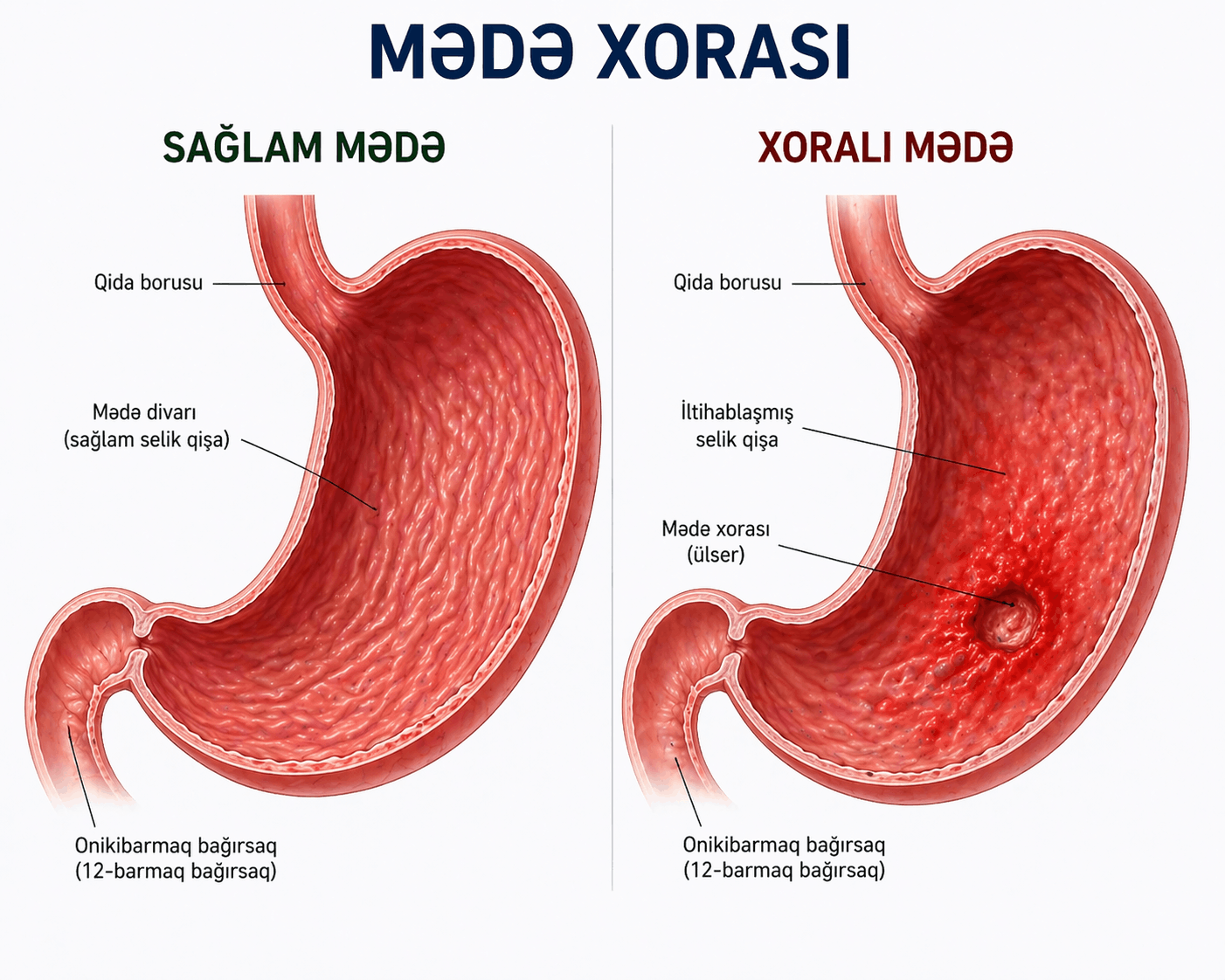 Mədə xorası olan xəstələr nəyə diqqət etməlidirlər