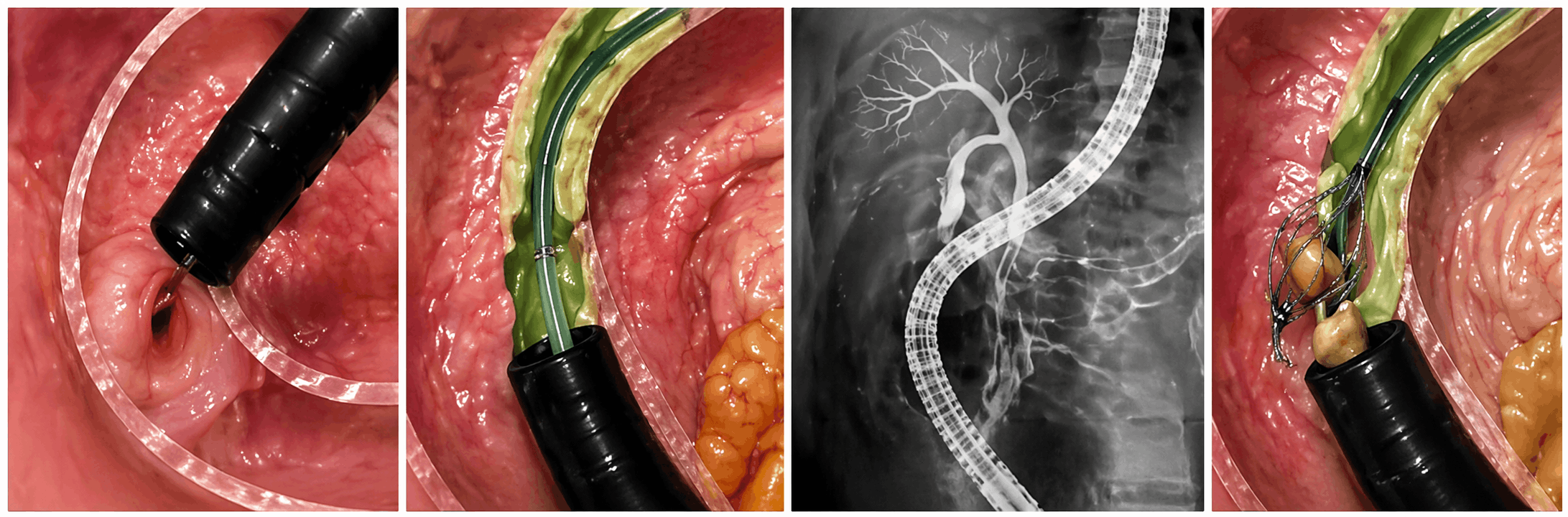 ERCP necə icra edilir və hansı alternativləri var?
