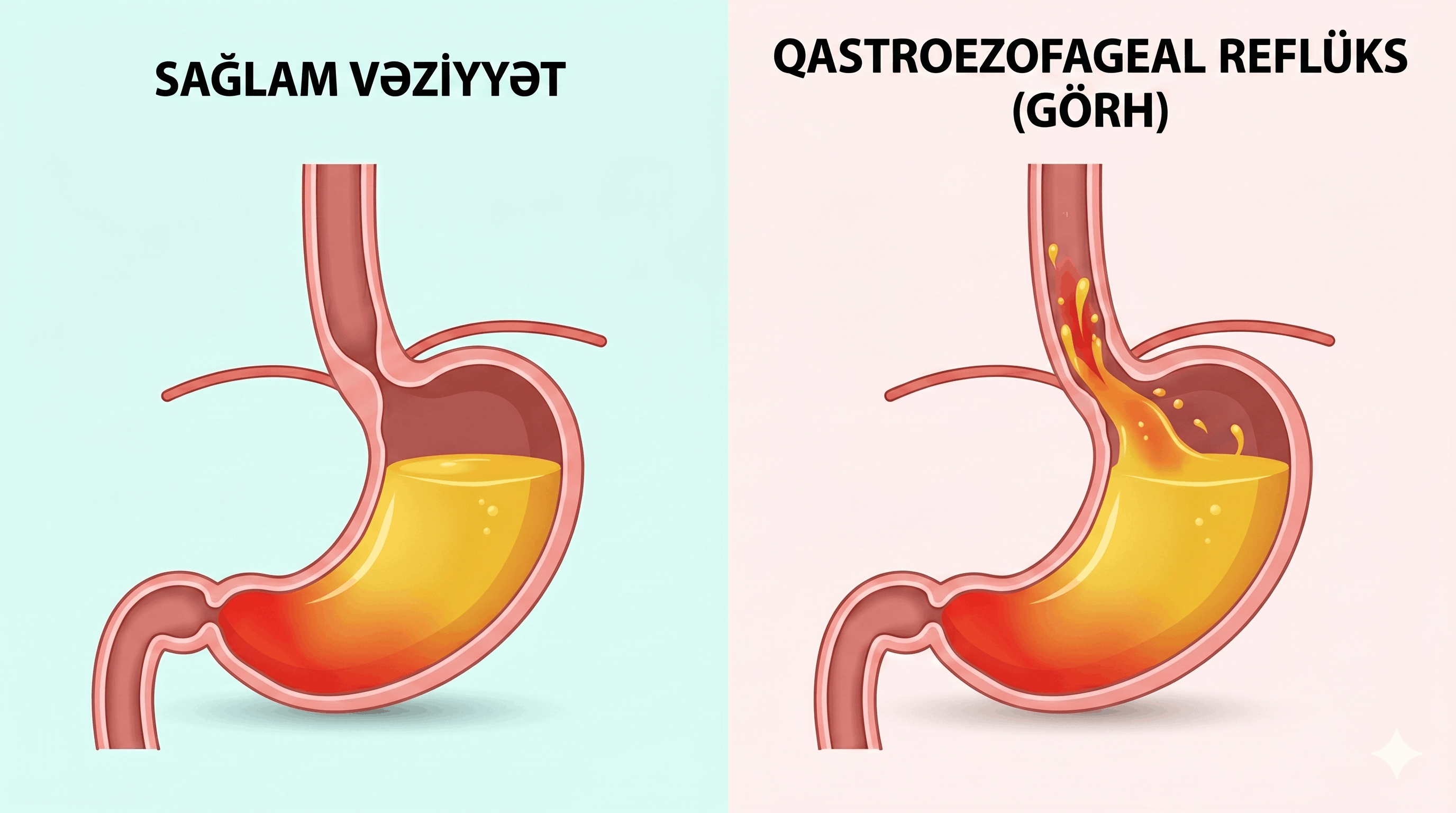 Qastroezofageal Reflüks